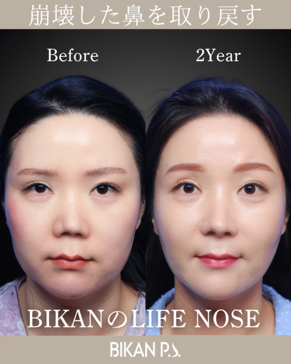 サイボーグのような鼻から、自然で美しい鼻へ