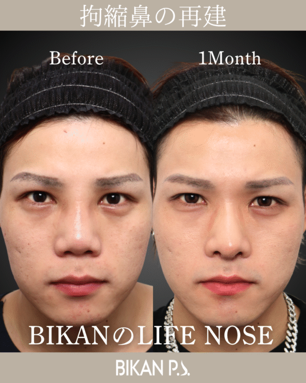拘縮鼻他院修正再建手術 × LIFE NOSE