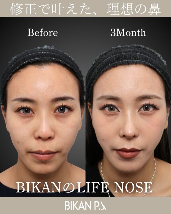 LIFE NOSEで実現した立体的で洗練された横顔