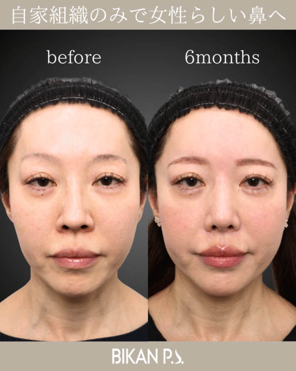 自家組織のみで女性らしい鼻へ