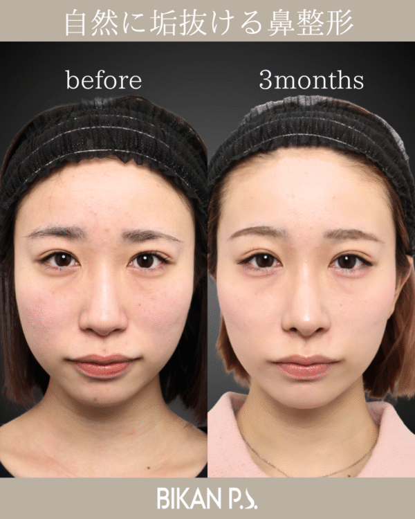 自然に垢抜ける鼻整形