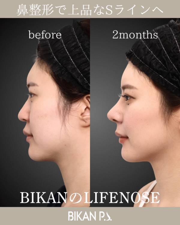 鼻整形で上品なSラインへ