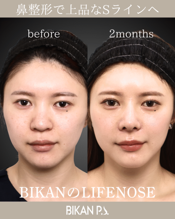 鼻整形で上品なSラインへ