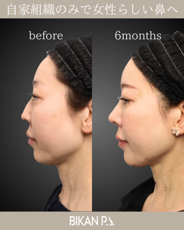 自家組織のみで女性らしい鼻へ