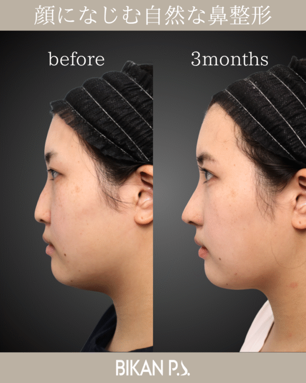 顔になじむ自然な鼻整形