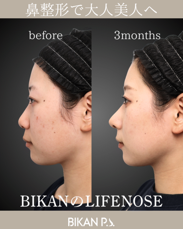 鼻整形で大人美人へ