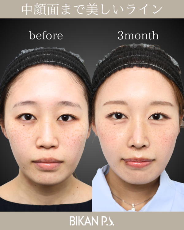 中顔面まで美しいライン