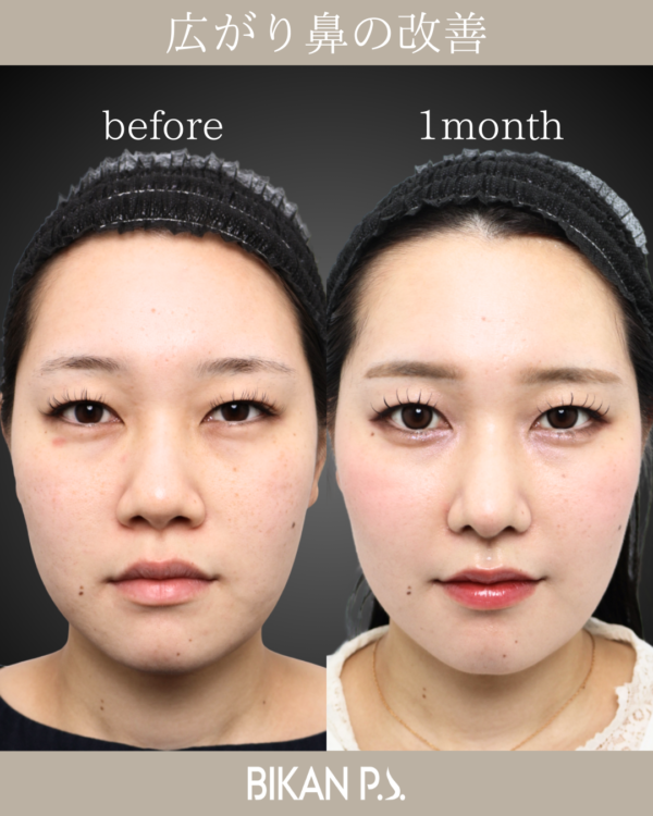 広がり鼻の改善