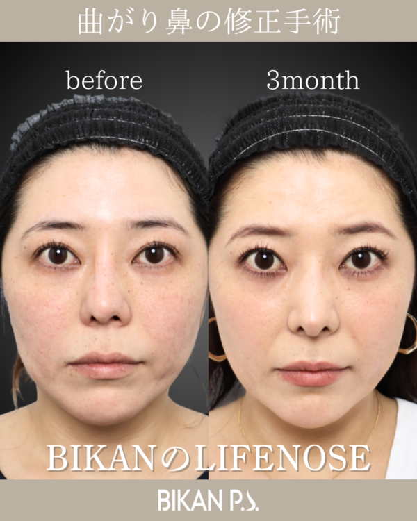 曲がり鼻の修正手術