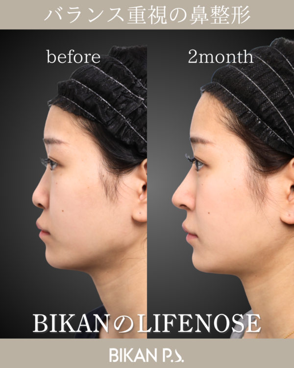 バランス重視の鼻整形