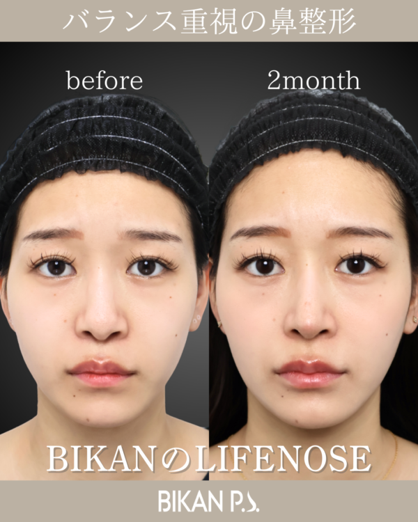 バランス重視の鼻整形