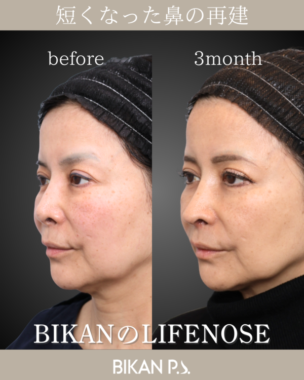 短くなった鼻の再建
