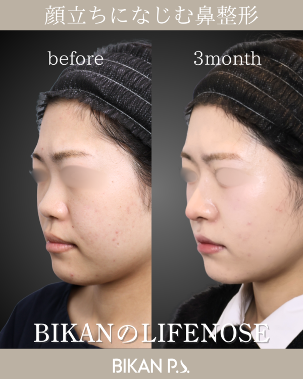 顔立ちになじむ鼻整形