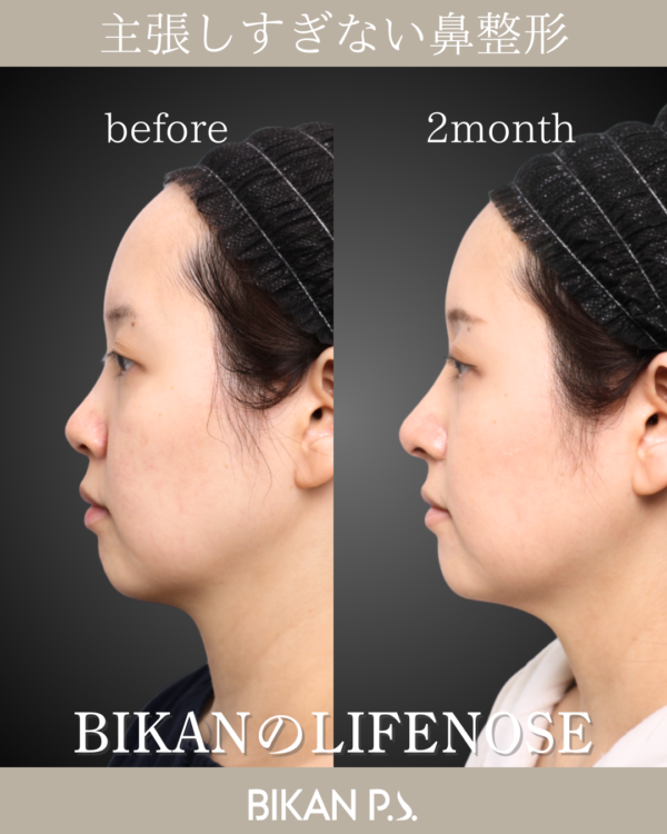 主張しすぎない鼻整形