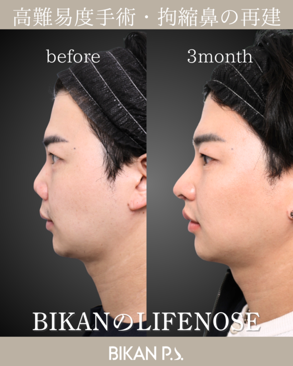 高難易度手術・拘縮鼻の再建