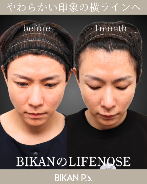 中性的でソフトな印象へ、鼻を整える