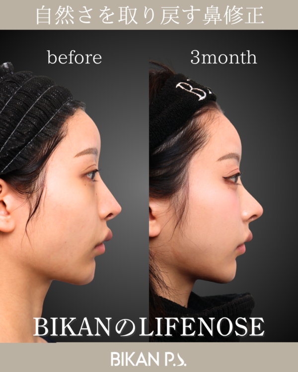 土台を作り直す、高難易度の鼻中隔再建