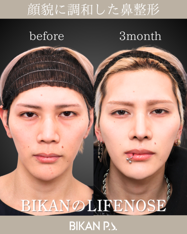 お顔に似合ったLIFE NOSE鼻整形