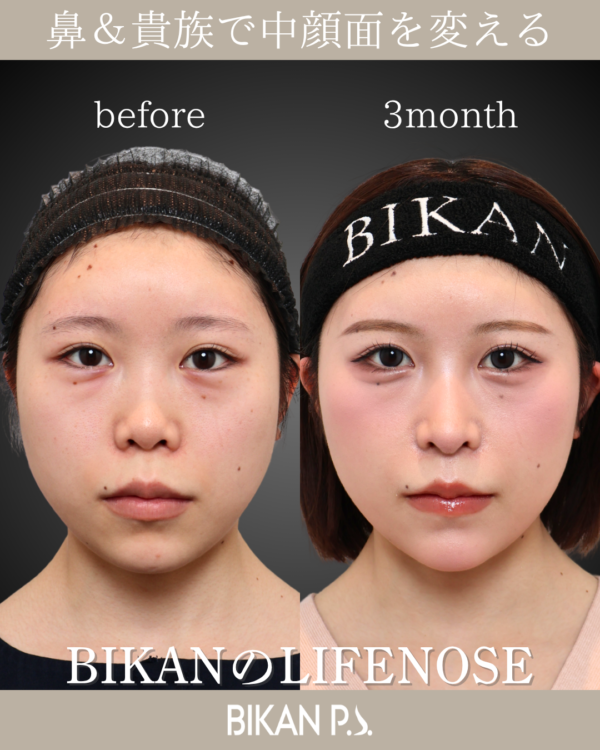 鼻整形のトレンドキー「中顔面」
