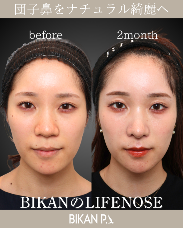 団子鼻を直し、ナチュラルに垢抜け