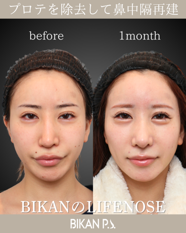 プロテを除去して再建。修正でも綺麗に垢抜け