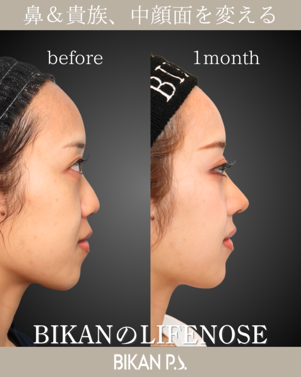 鼻＆貴族で中顔面から口元まで激変