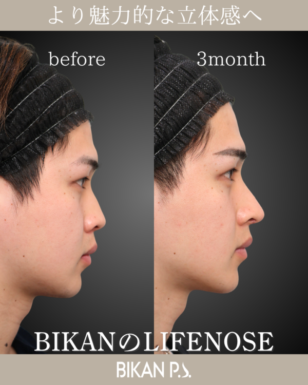 自家組織で安全でカッコよく鼻先「LIFE NOSE」