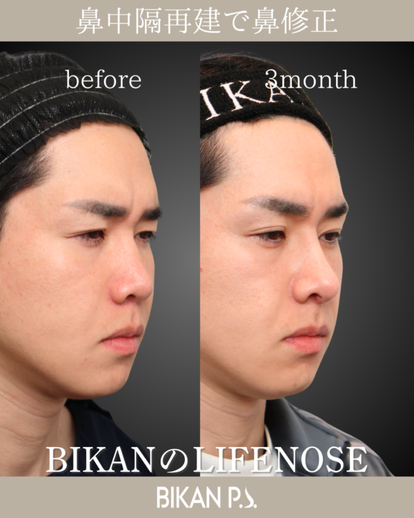 硬い皮膚は人中フラップで、理想を叶える