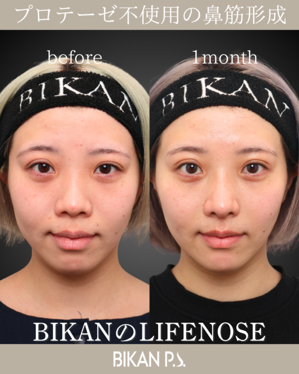 「傷跡」怖くない、丁寧な小鼻縮小