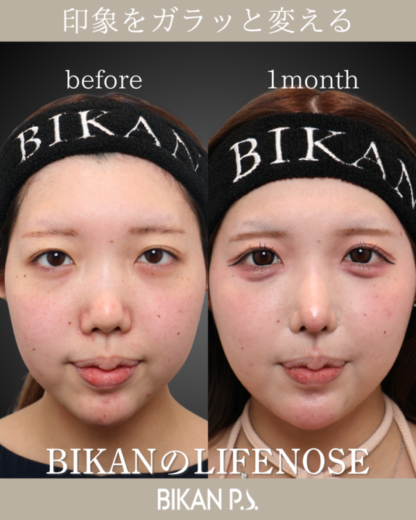 再手術も怖くない「フル自家組織」で修正