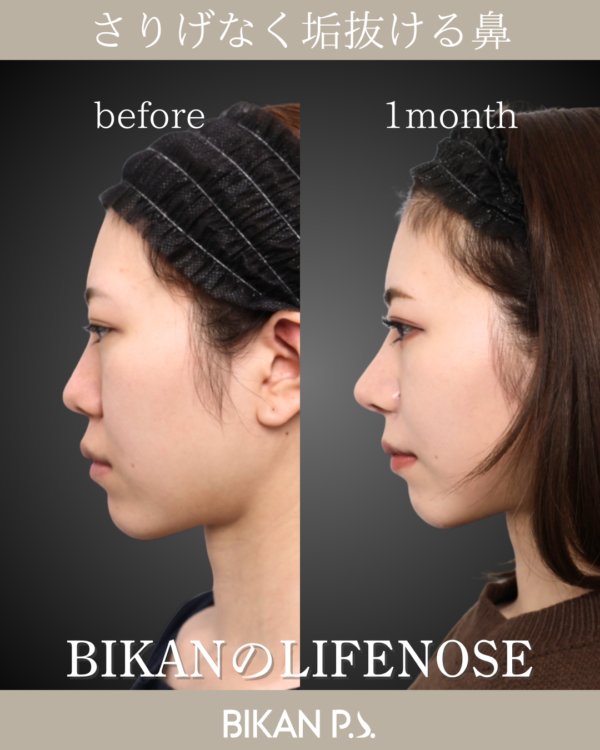 さりげなく「確実な垢抜け」へ導く鼻整形