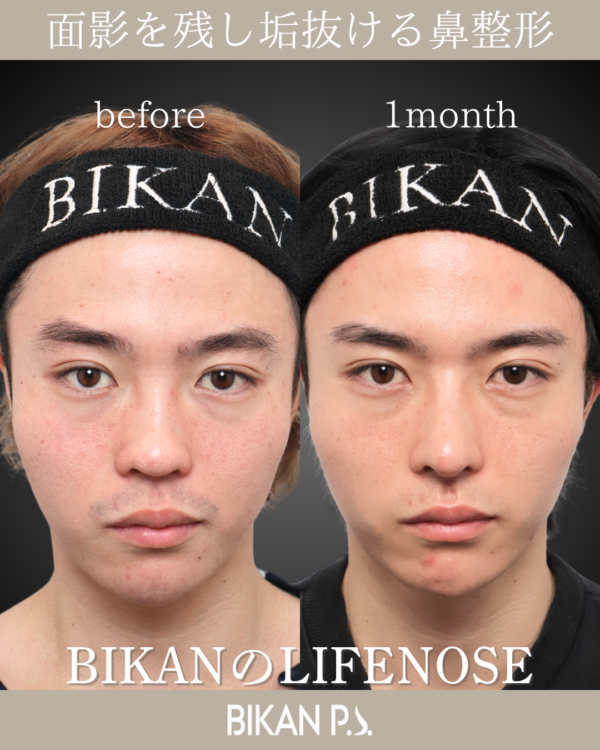 ヒアルロン酸はもう卒業。安全で安心できるLIFENOSE