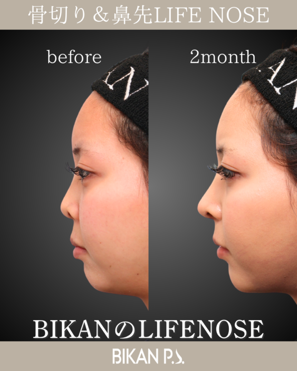 ナチュラルに鼻中隔延長。洗練された印象へ