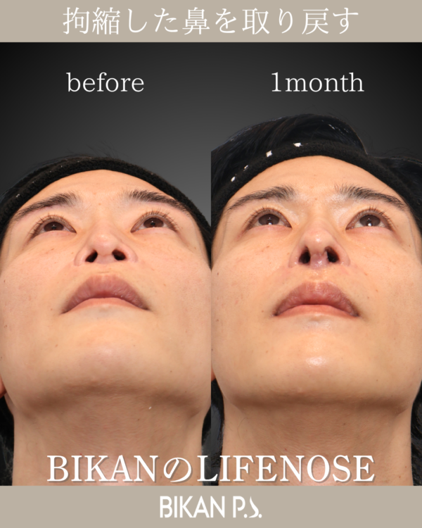再生治療から「拘縮鼻」の再建手術ができるまで