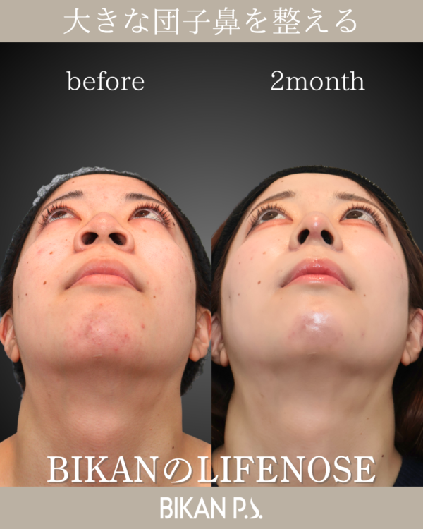 大きな団子鼻を改善する小鼻縮小＆LIFENOSE