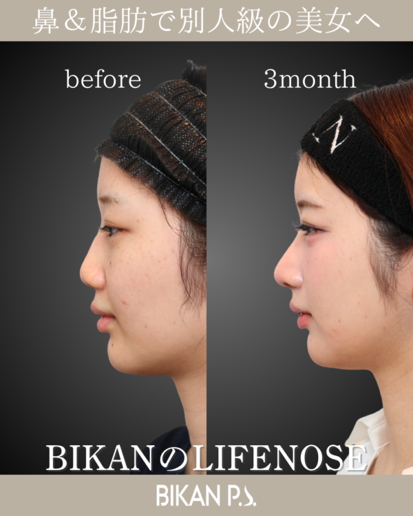 鼻と脂肪を同時に。別人のような変化