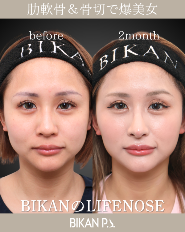 骨切り幅寄せで整えるLIFENOSE