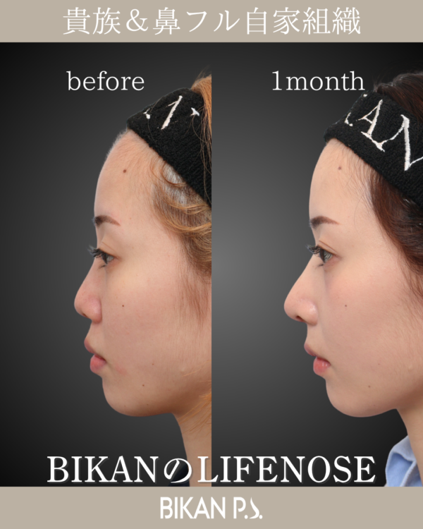貴族から鼻まですべて自家組織。LIFE NOSE