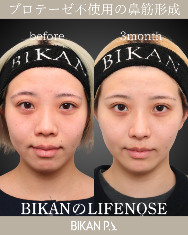 傷跡を残さない小鼻縮小とLIFENOSE