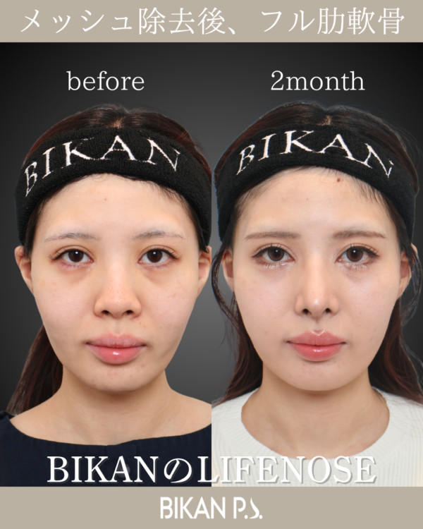メッシュを除去してLIFE NOSEで他院修正。