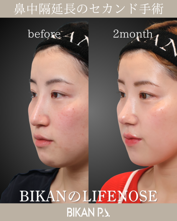 プロテーゼを丁寧に除去して修正するLIFE NOSE