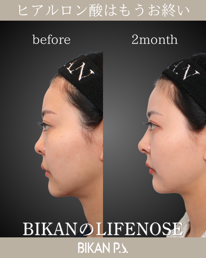 他院修正による鼻整形症例 術前・術後2ヶ月 横顔 BIKAN CLINIC