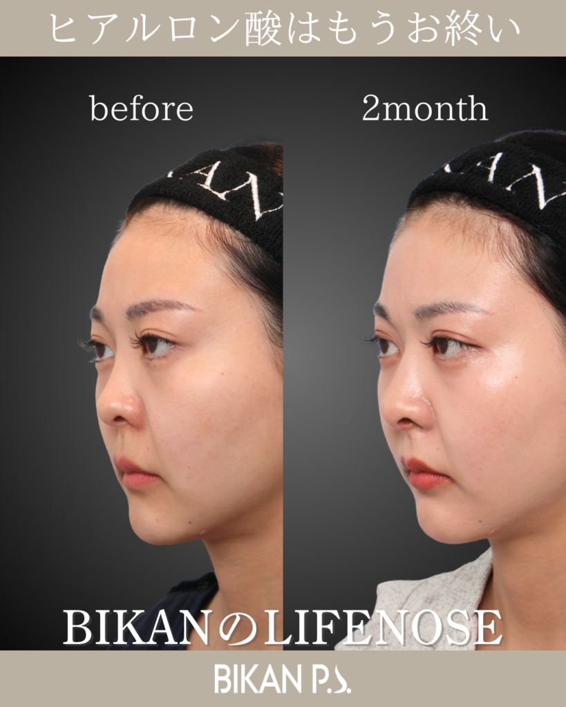 他院修正による鼻整形症例 術前・術後2ヶ月 斜め BIKAN CLINIC
