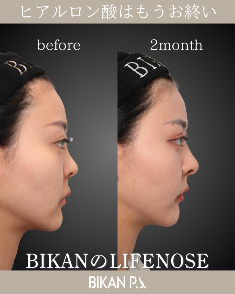 他院修正による鼻整形症例 術前・術後2ヶ月 横顔 BIKAN CLINIC