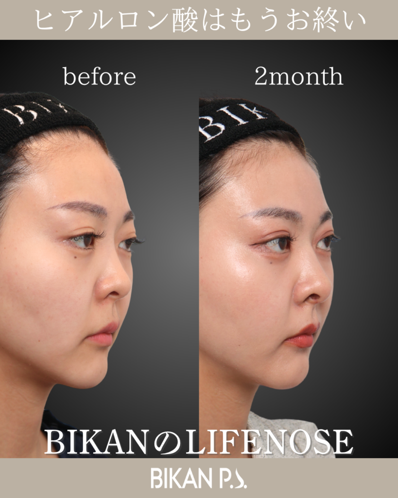 他院修正による鼻整形症例 術前・術後2ヶ月 斜め BIKAN CLINIC