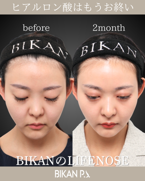 ヒアルロン酸注入歴のある鼻を自家組織で改善｜LIFE NOSE・貴族肋軟骨｜術後2ヶ月