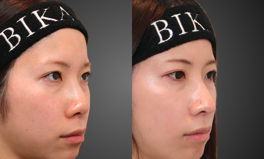 初手術 小鼻縮小症例 術前・術後3ヶ月 右斜め BIKAN