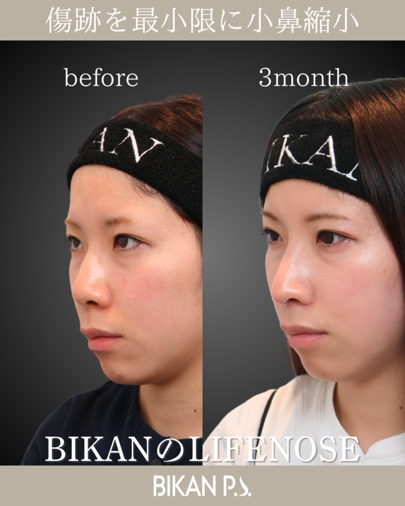 初手術 小鼻縮小症例 術前・術後3ヶ月 左斜め BIKAN