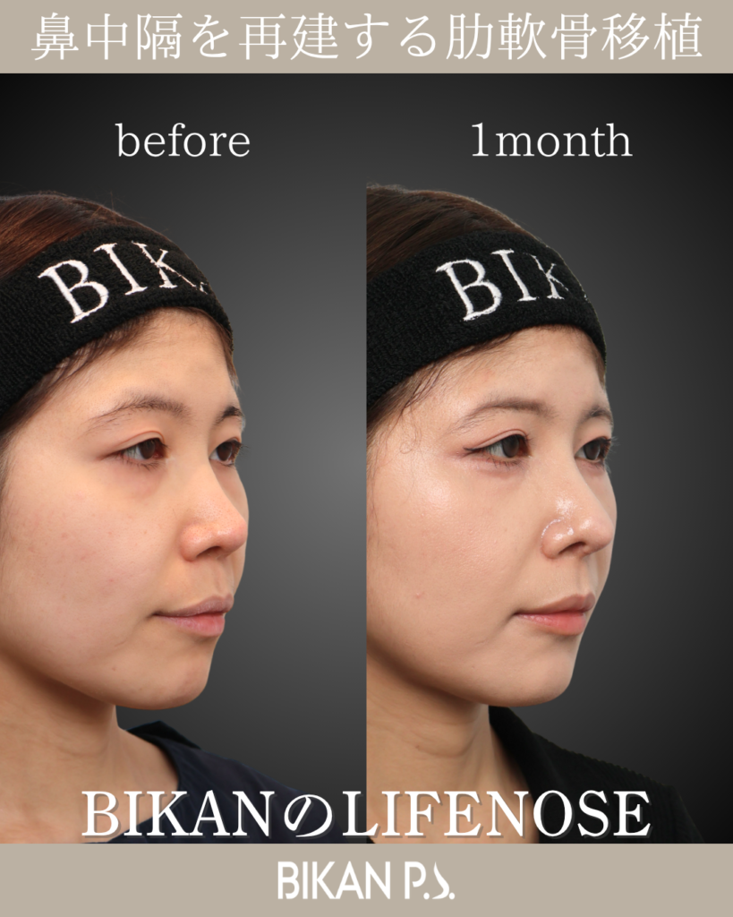 他院修正鼻整形症例 術前・術後1ヶ月 斜め BIKAN CLINIC