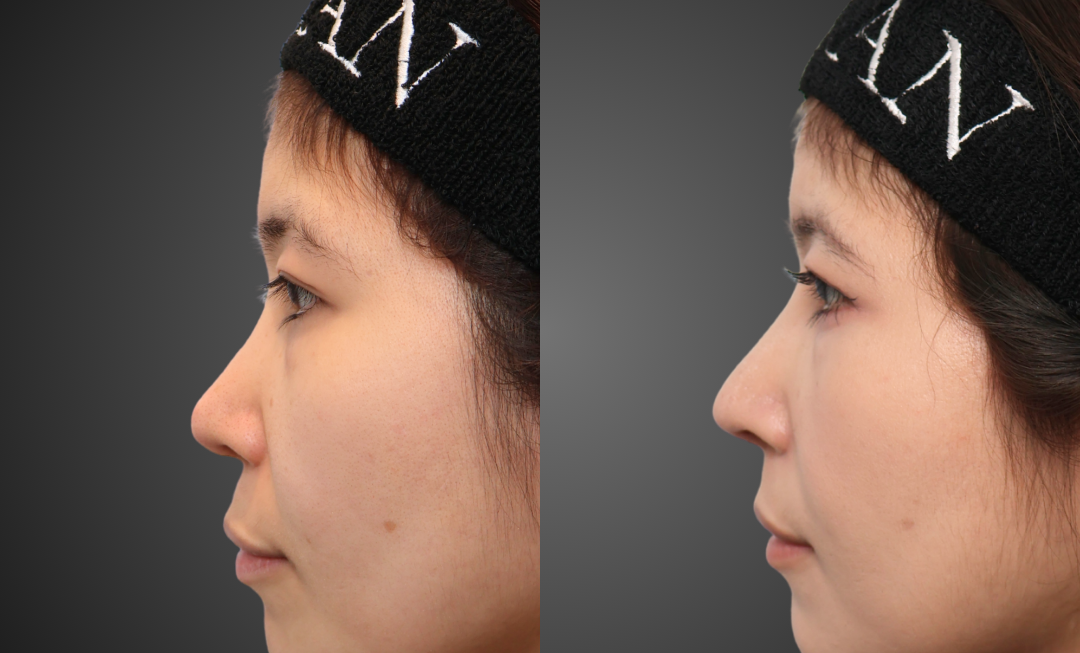 他院修正鼻整形症例 術前・術後1ヶ月 側面 BIKAN CLINIC